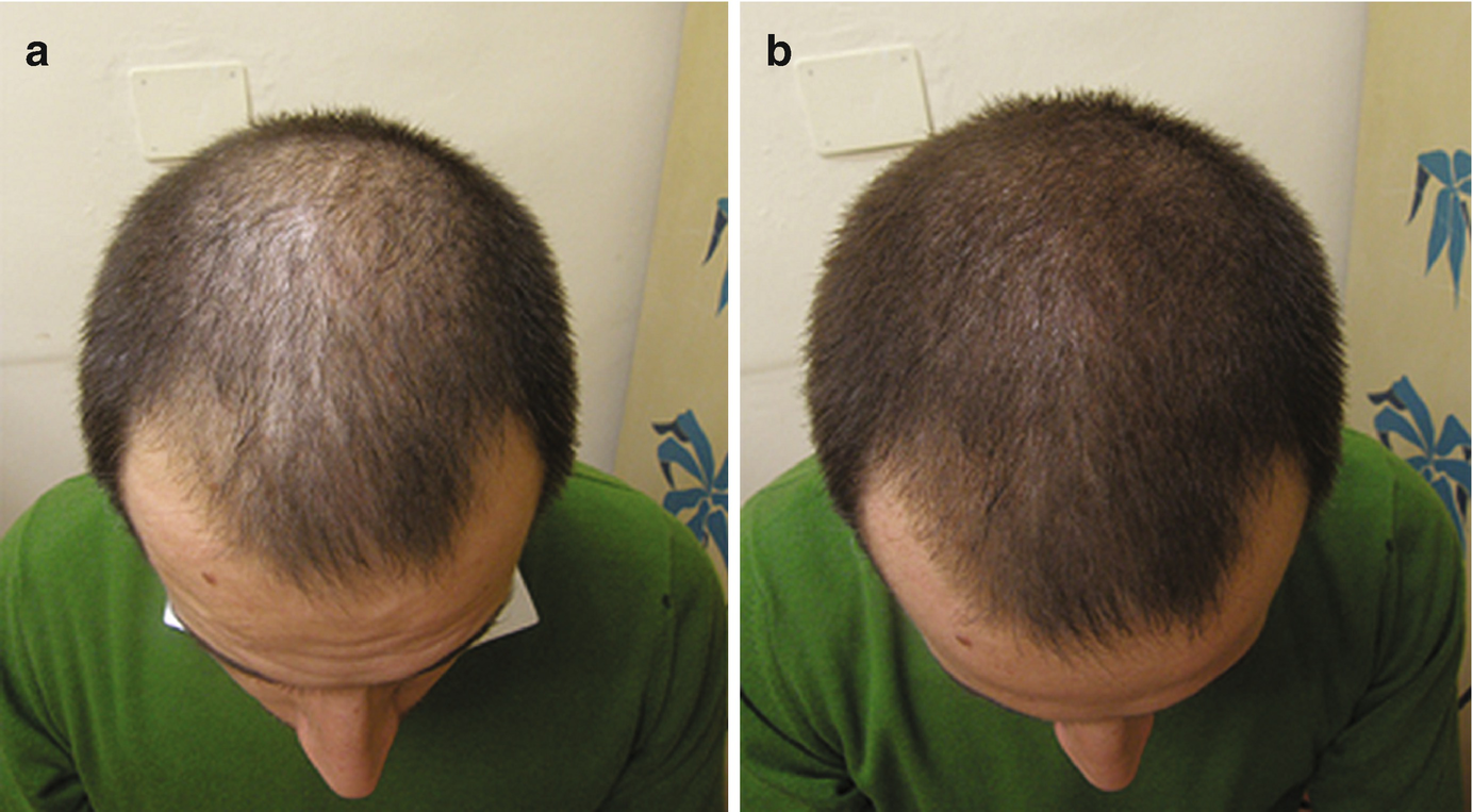 Camouflage Extensions And Electrical Devices To Improve Hair Volume Springerlink