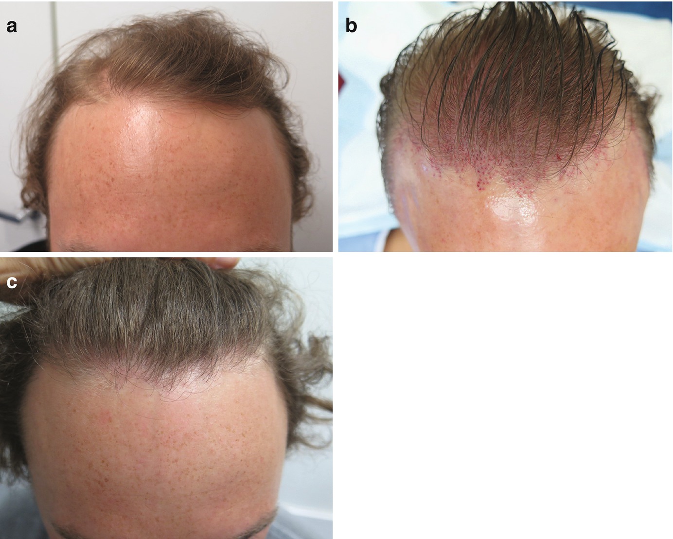 What You Need to Know About Hair Transplantation  SpringerLink
