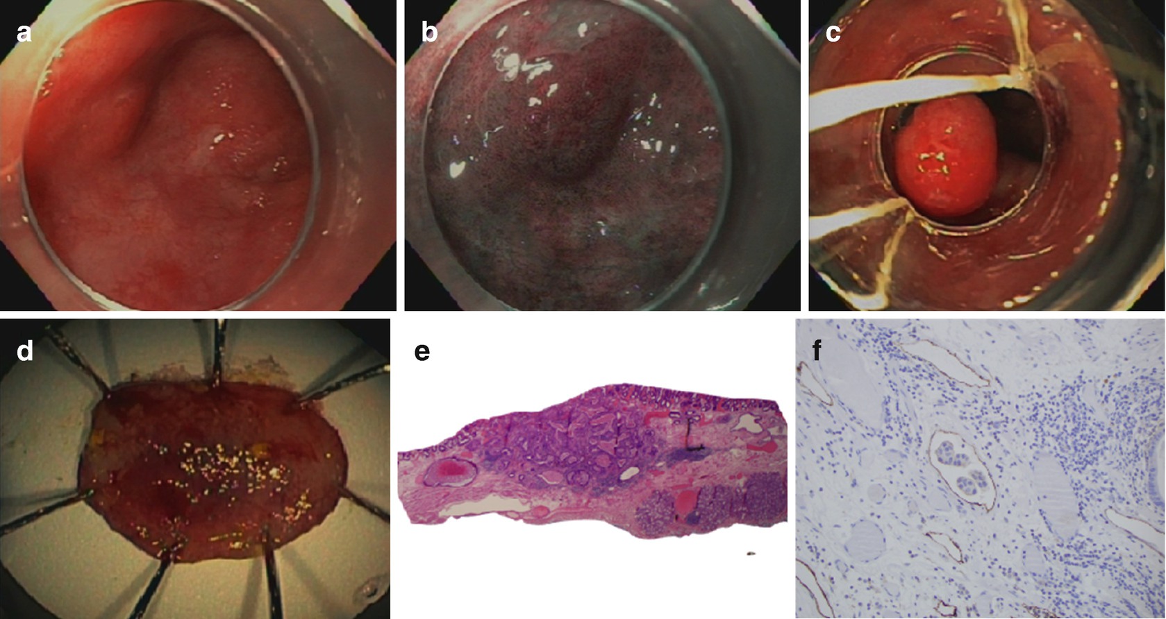 Endoscopic Mucosal Resection Of The Esophagus Springerlink