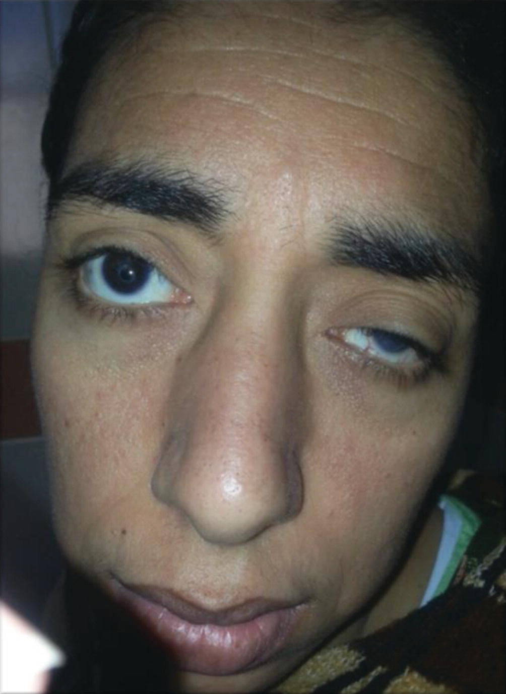 Angiomas Associated With Deafness Blindness And Renal Carcinoma Springerlink