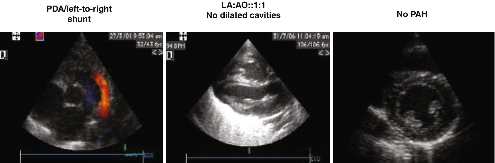| Ductus SpringerLink Patent Arteriosus
