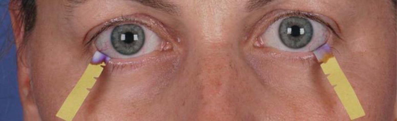 22 éves prostatitis
