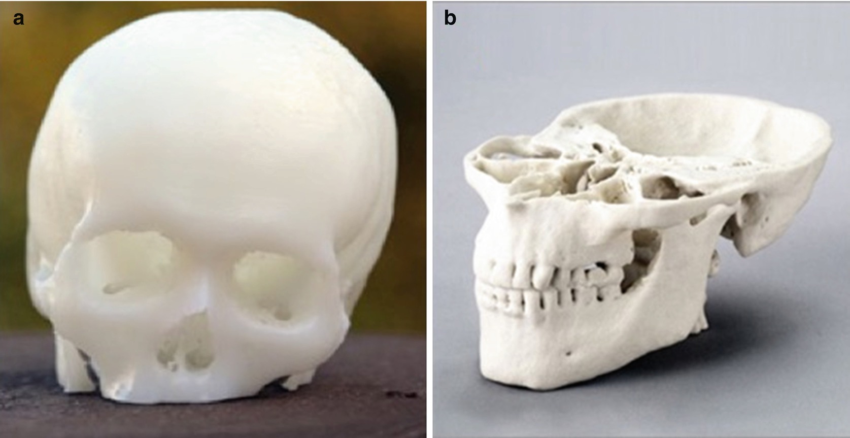 Virtual Endoscopy And 3 D Reconstruction In The Nose Paranasal Sinuses And Skull Base Surgery New Frontiers Springerlink Virtual Endoscopy And 3 D Reconstruction In The Nose Paranasal Sinuses And Skull Base Surgery New Frontiers Springerlink