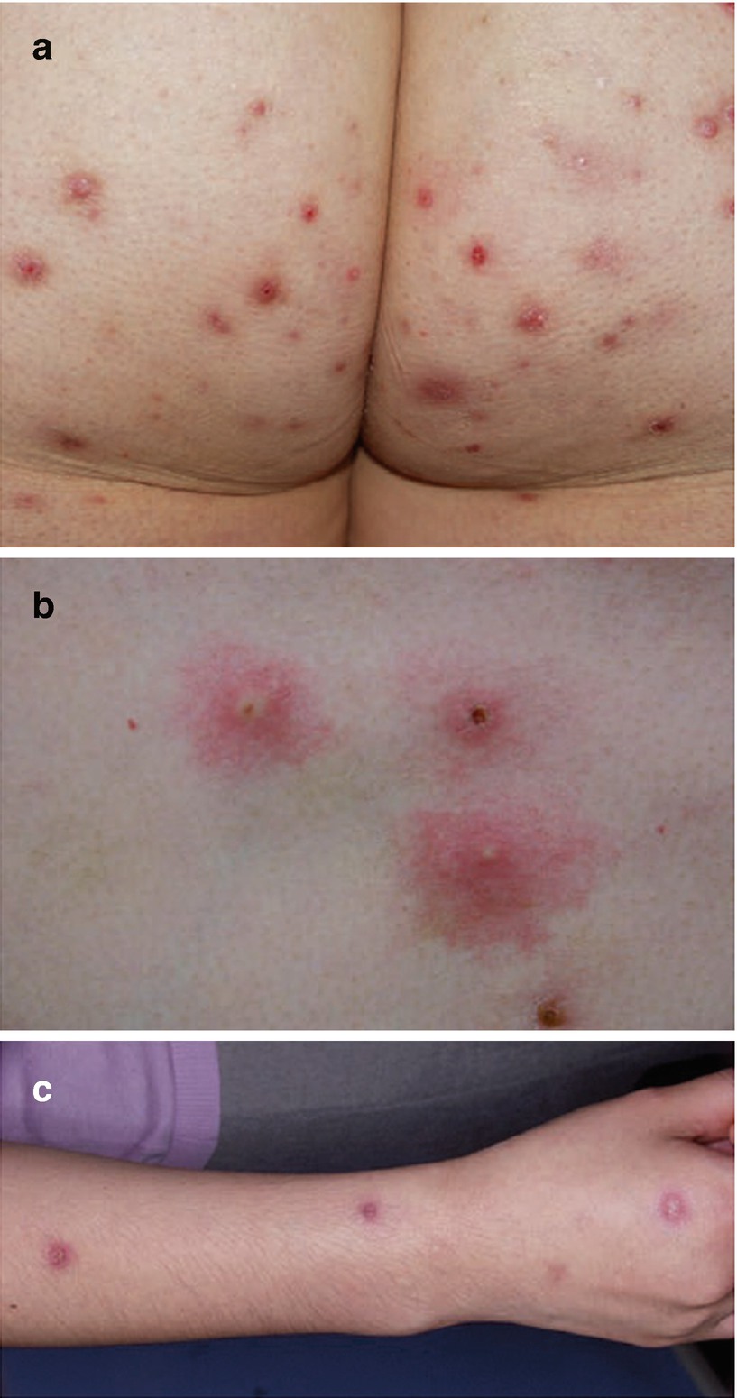 pix Skin Rash Behcet's Disease Rash pathergy reaction in behcet syndrome