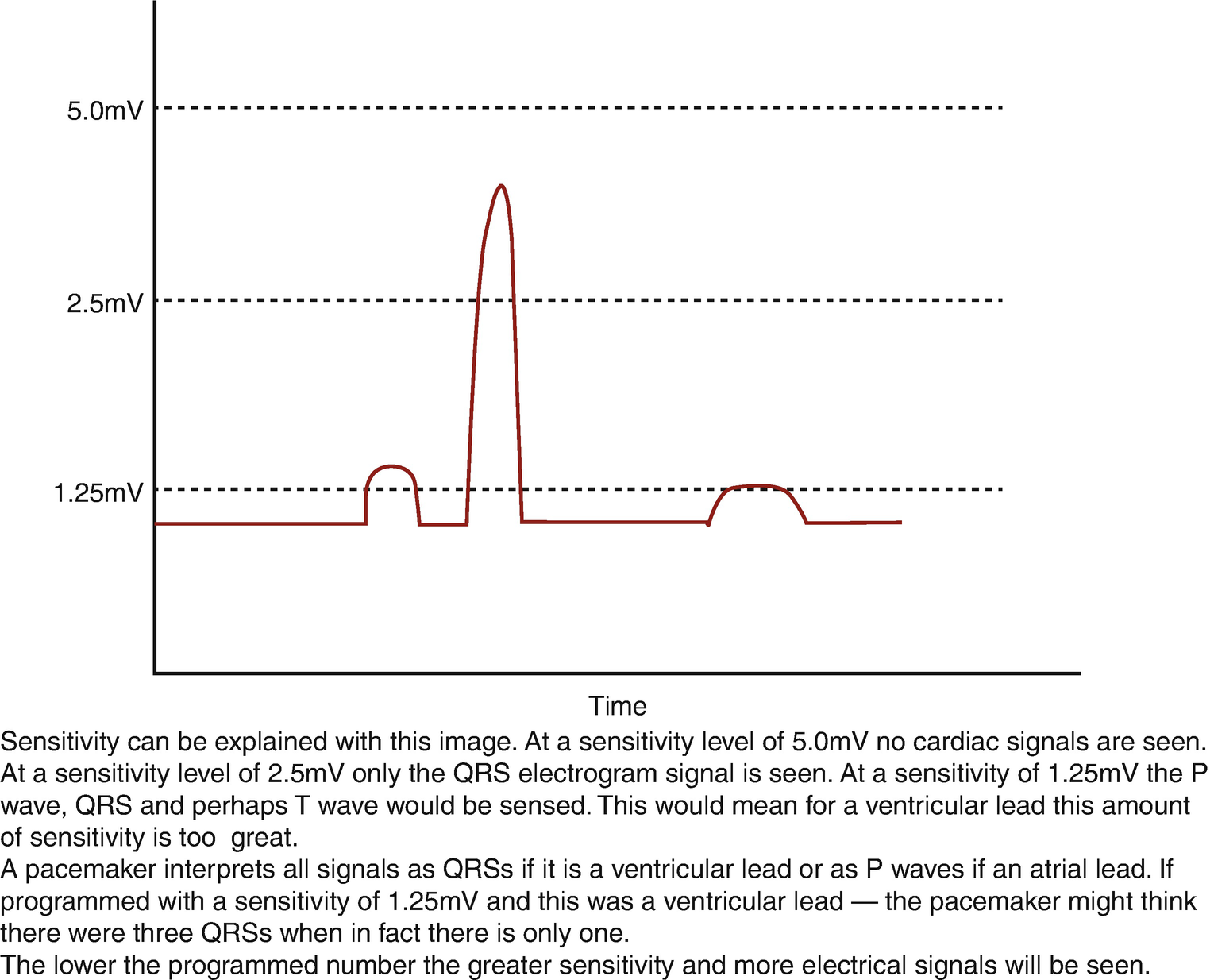 Cardiac Pacing In Adults Springerlink Cardiac Pacing In Adults Springerlink