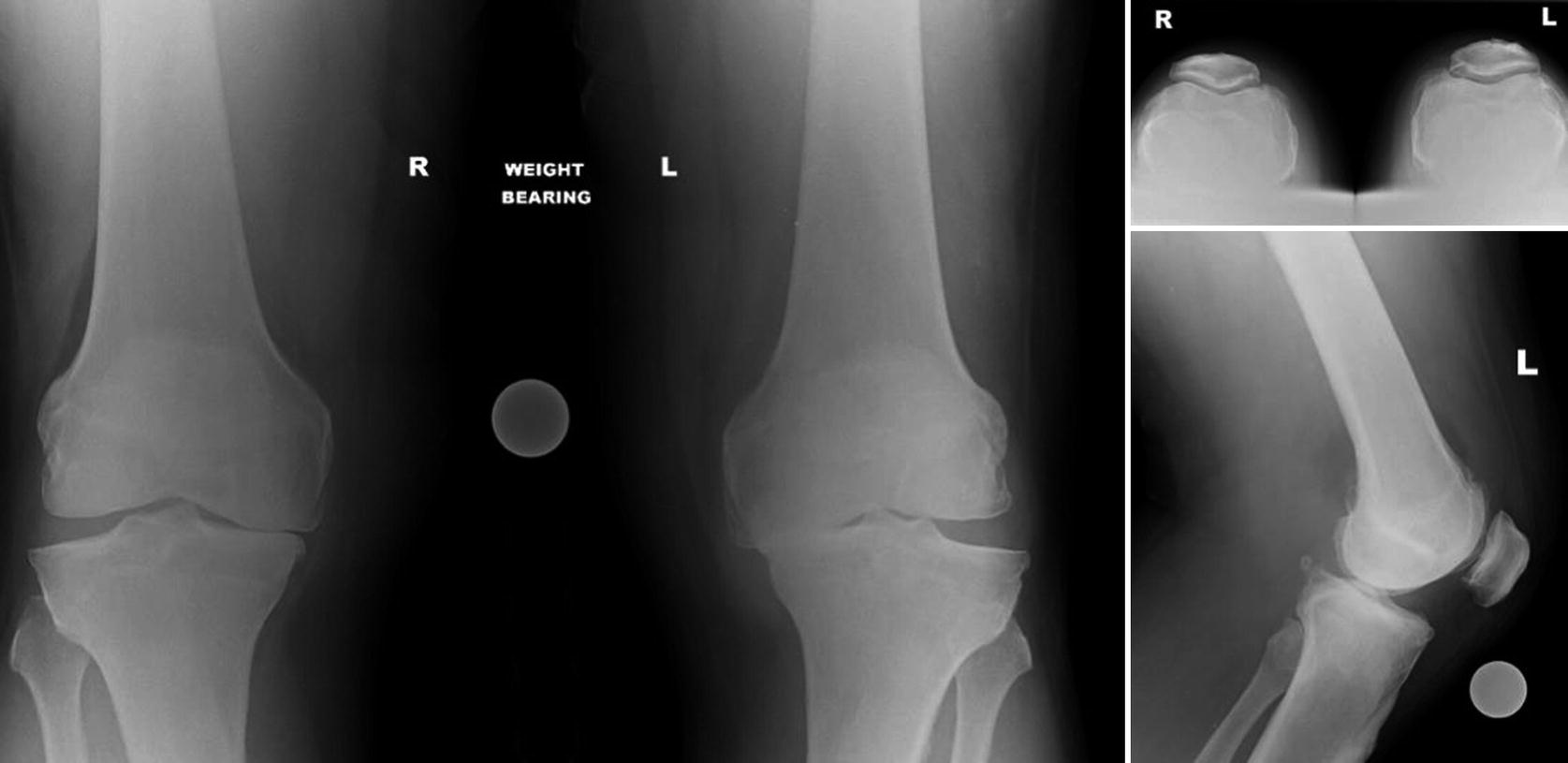 The Kinematic Alignment Technique for Total Knee Arthroplasty ...