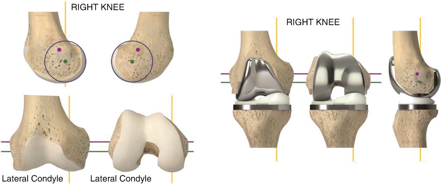 The Kinematic Alignment Technique for Total Knee Arthroplasty ...