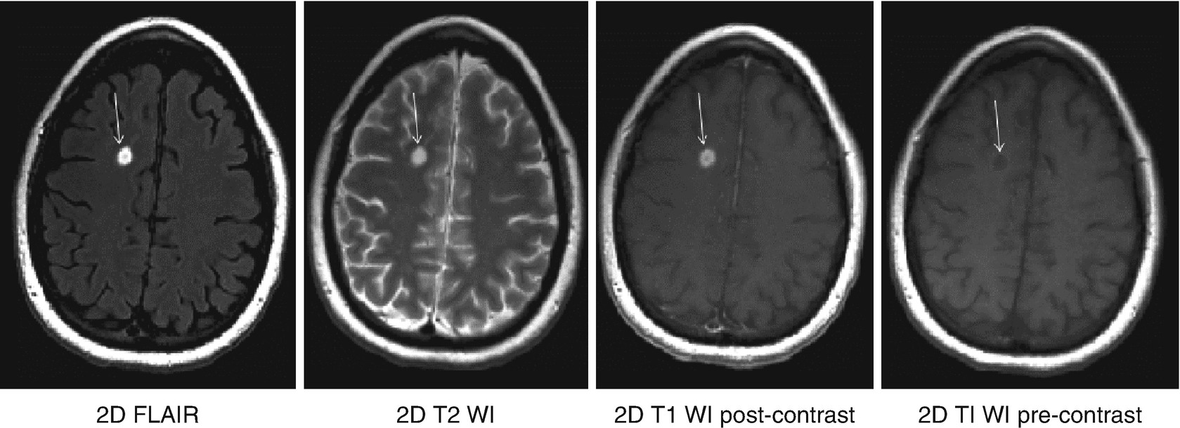 Magnetic Resonance Imaging And Analysis In Multiple Sclerosis Springerlink