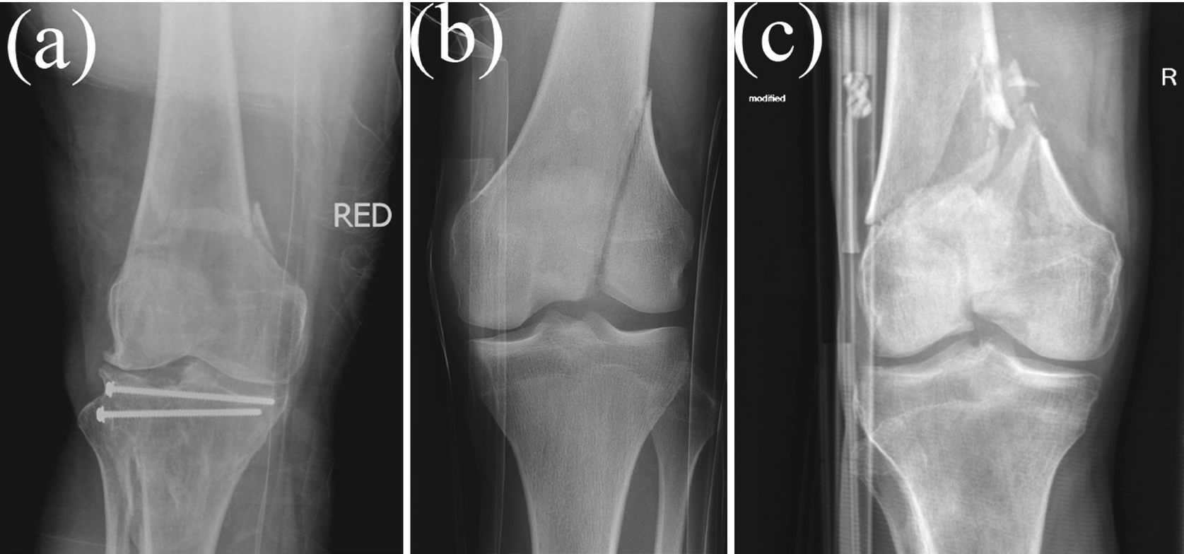 articular femur fractures