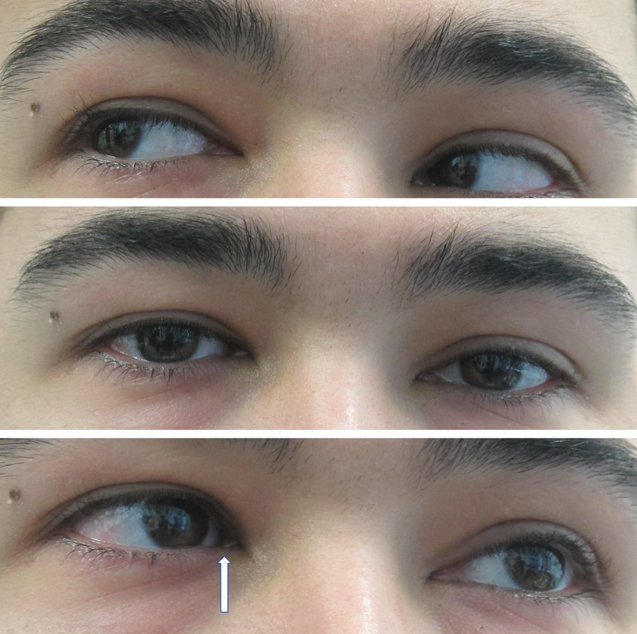 Concomitant Strabismus Springerlink