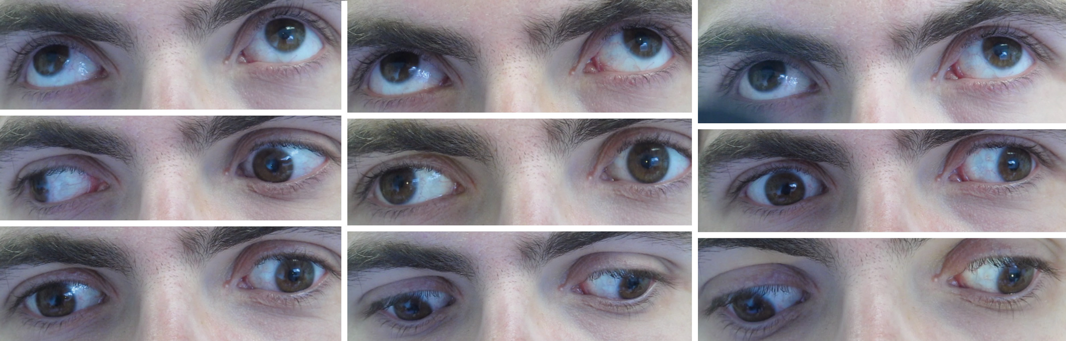 Concomitant Strabismus Springerlink Concomitant Strabismus Springerlink