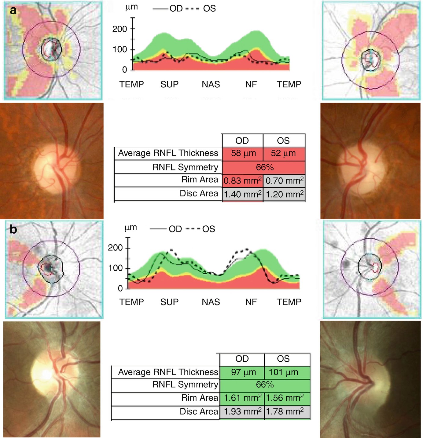 Hereditary Optic Neuropathies Springerlink