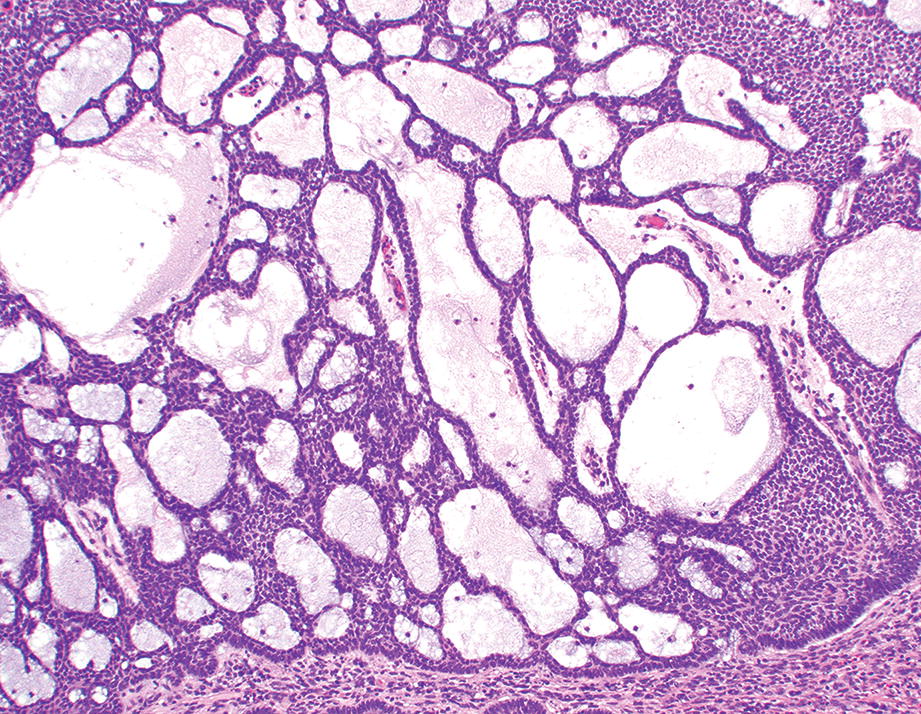 Basal Cell Carcinoma Histology
