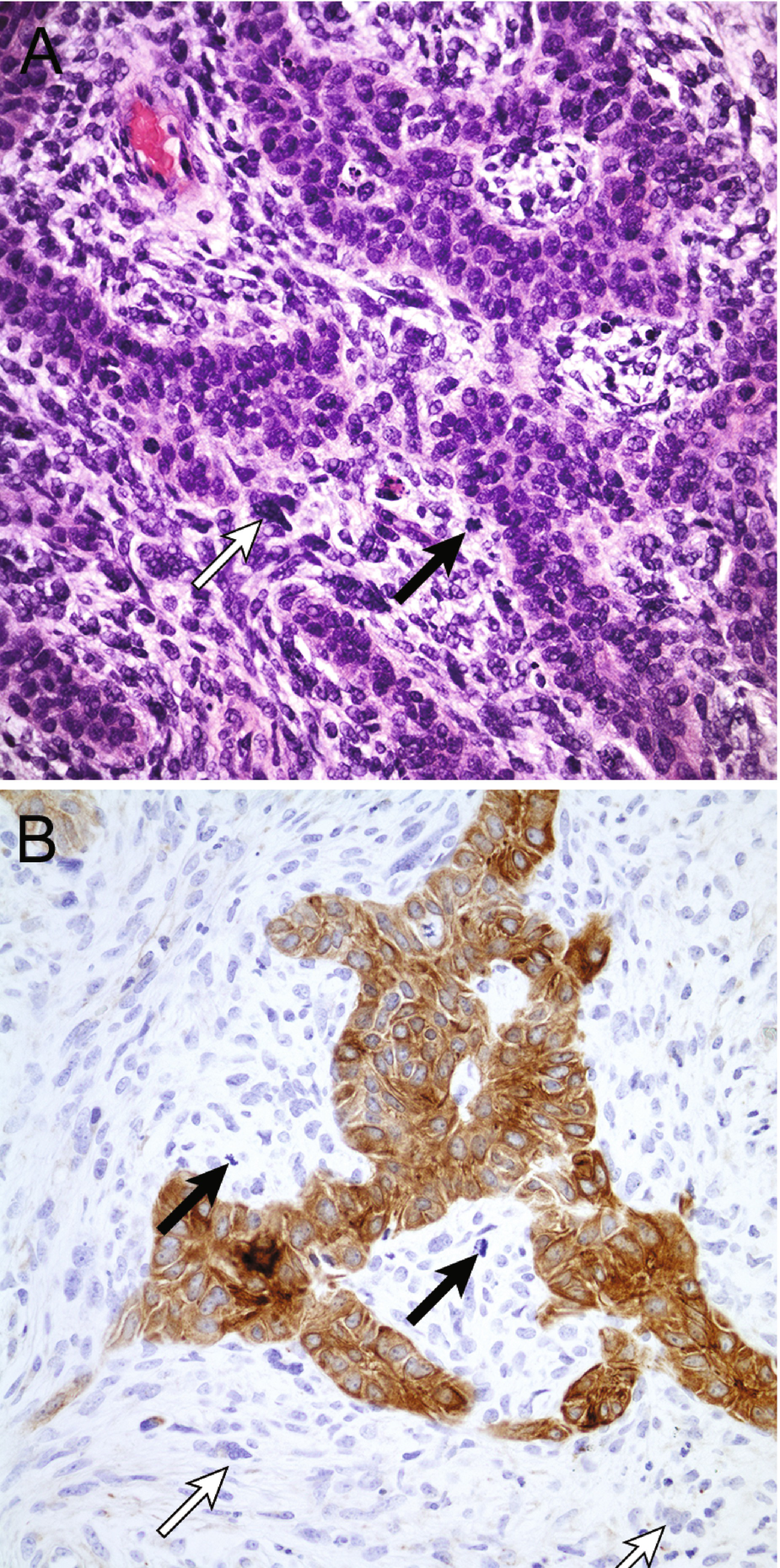 Basal Cell Carcinoma Histology