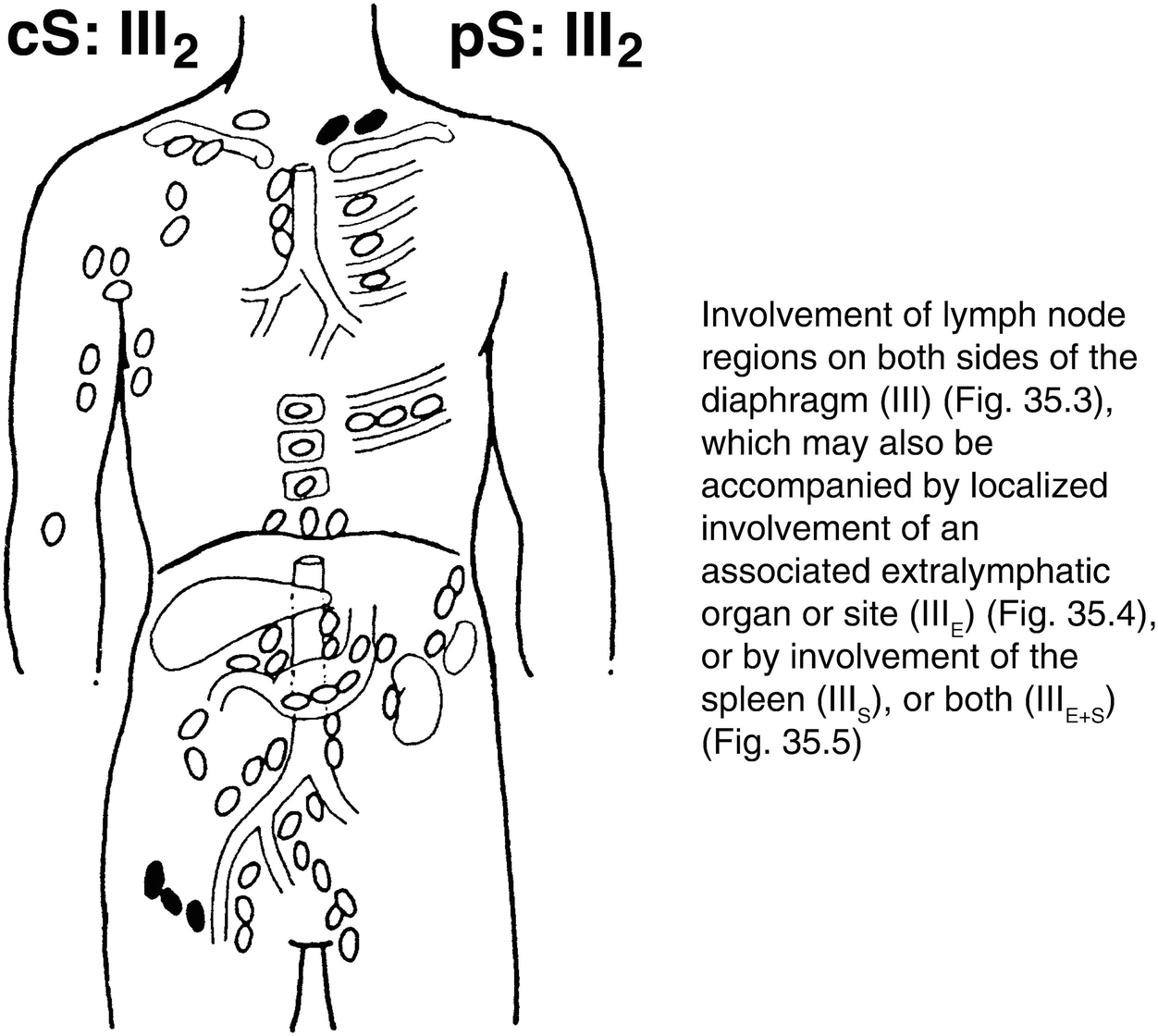 Nodal Malignant Lymphoma With Comments On Extranodal Malignant Lymphoma And Metastatic Cancer Springerlink
