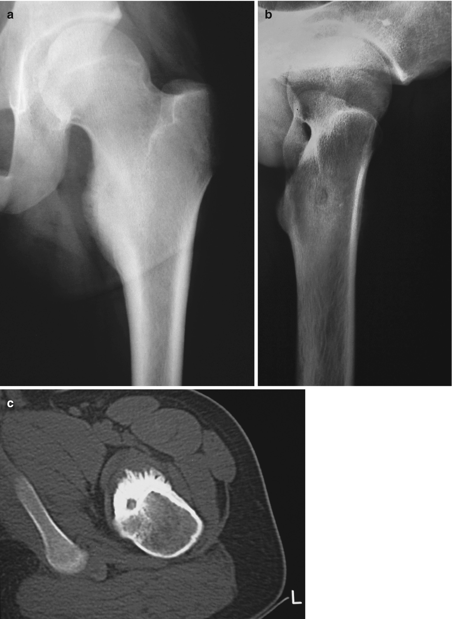 Osteoid Osteoma Springerlink
