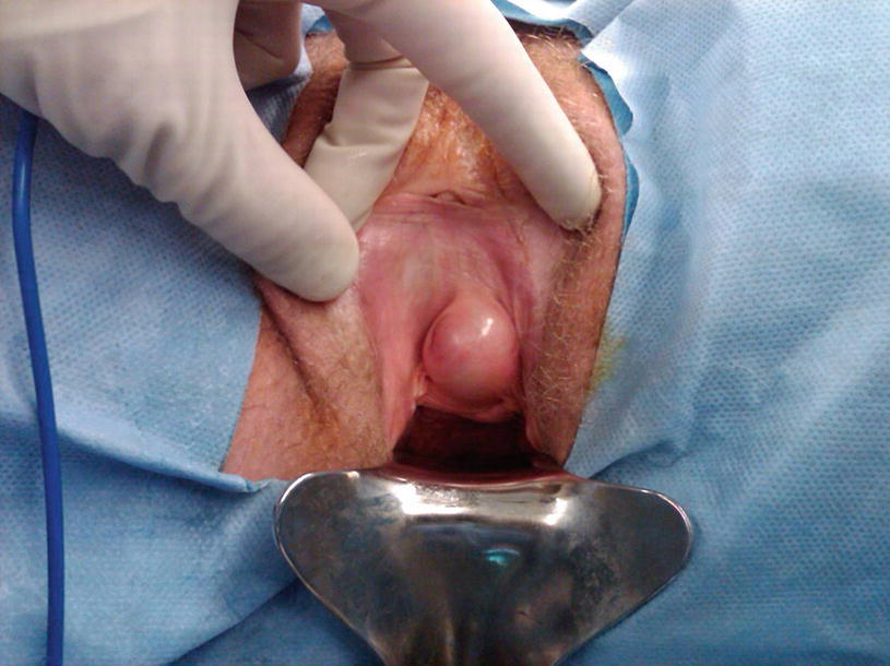 Prevention Of Ureteral Injuries In Gynecologic Surgery