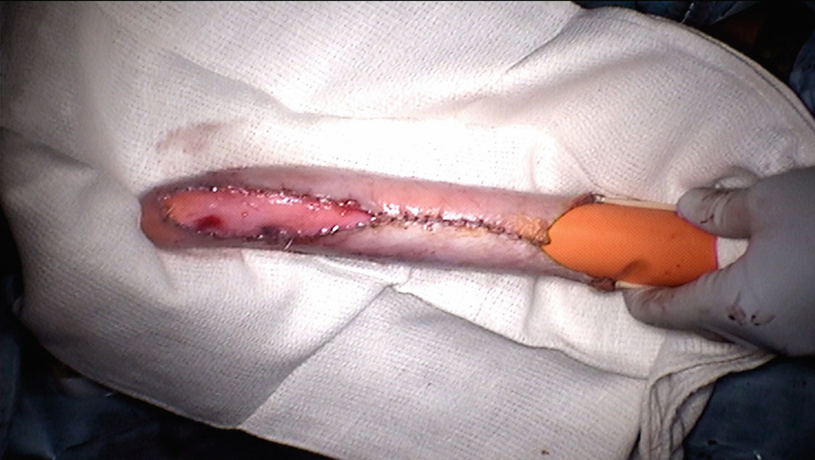 Penile Inversion Vaginoplasty | SpringerLink Penile Inversion Vaginoplasty | SpringerLink