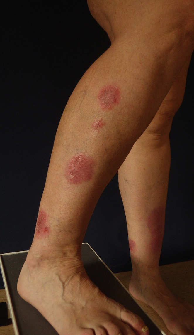 Management Of Eczema Dermatitis In Adults Springerlink