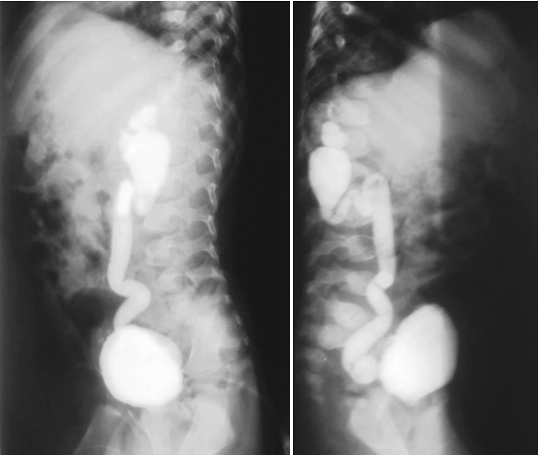 Posterior Urethral Valve Springerlink