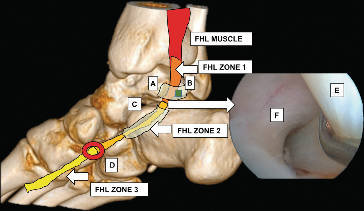 Flexor Hallucis Longus Tendinopathy Springerlink