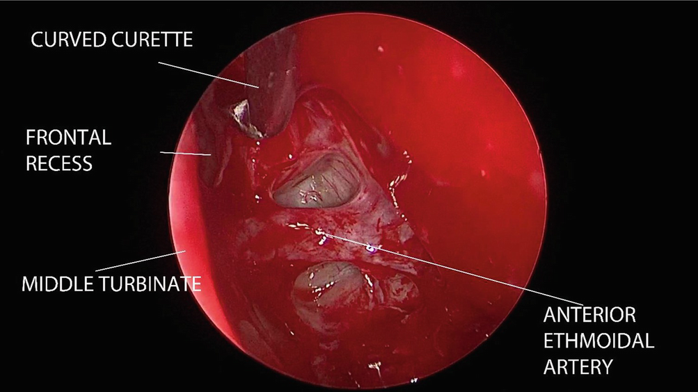 Surgery For Rhinosinusitis And Rhinogenic Headache Springerlink Surgery For Rhinosinusitis And Rhinogenic Headache Springerlink