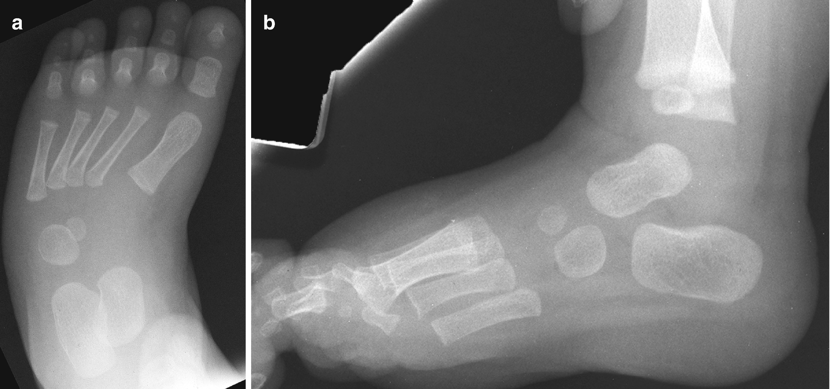 Radiology Of The Pediatric Foot And Ankle Springerlink