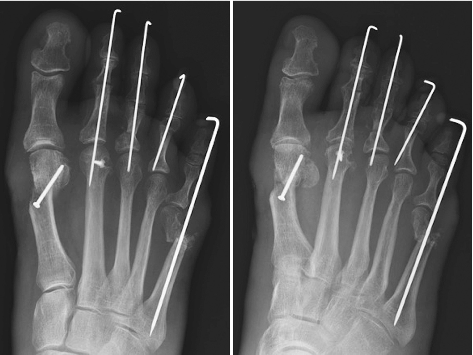 Revision Surgery for the Failed Hammer Toe | SpringerLink