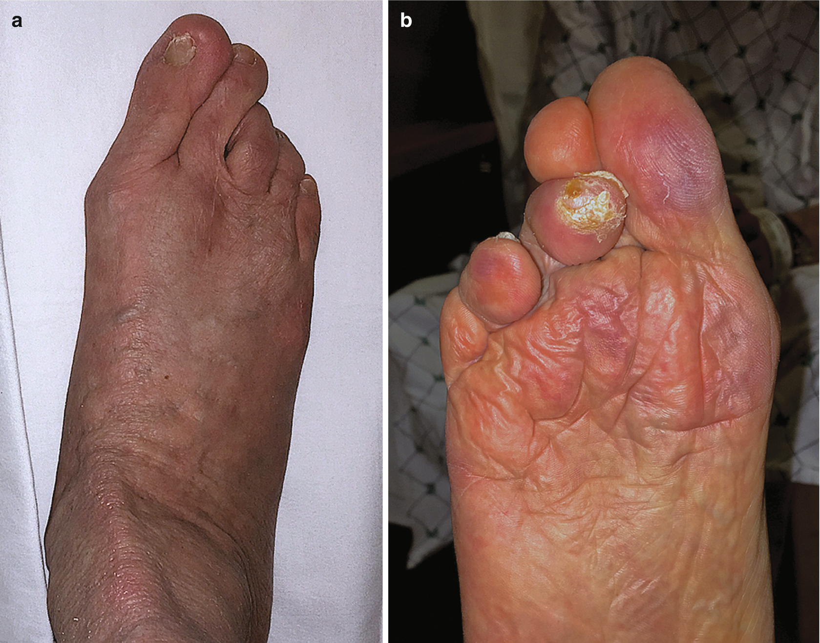 Revision Surgery for the Failed Hammer Toe | SpringerLink Revision Surgery for the Failed Hammer Toe | SpringerLink