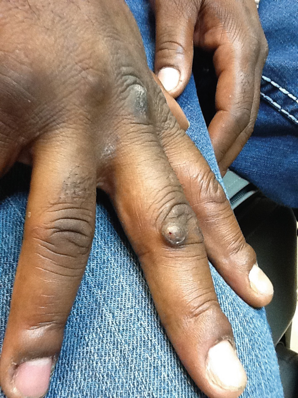 warts on dark skin un leac pentru paraziți pentru întreaga familie