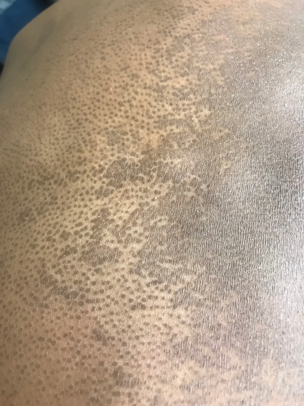Cutaneous Infections In Black Skin Springerlink