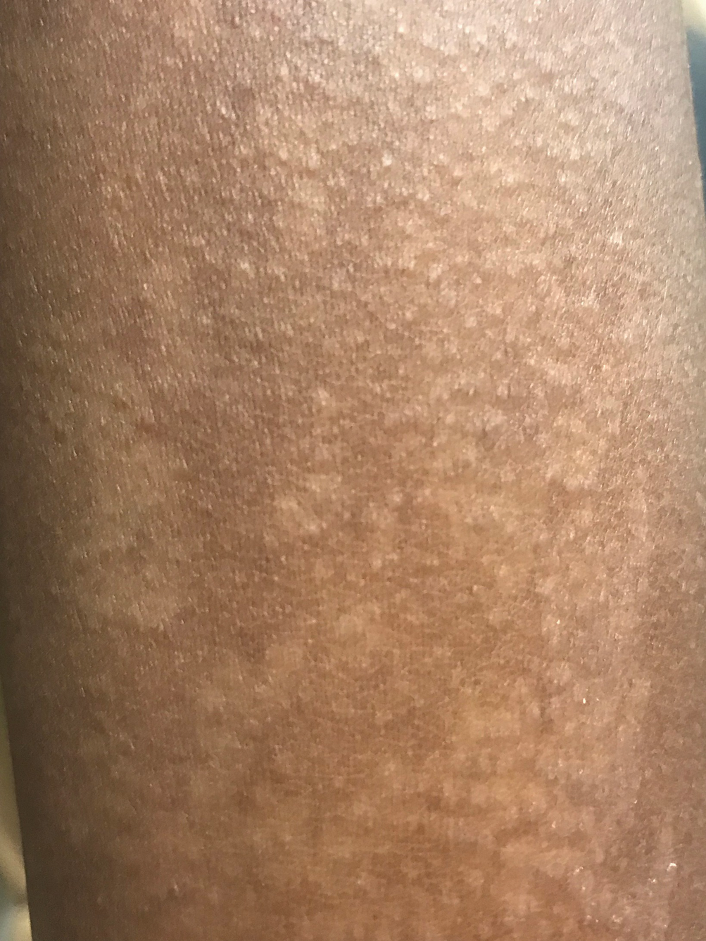 Cutaneous Infections In Black Skin Springerlink