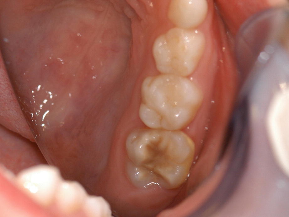 Treatment Of Children With Mih A Challenge In Pain Control And Behaviour Management Springerlink