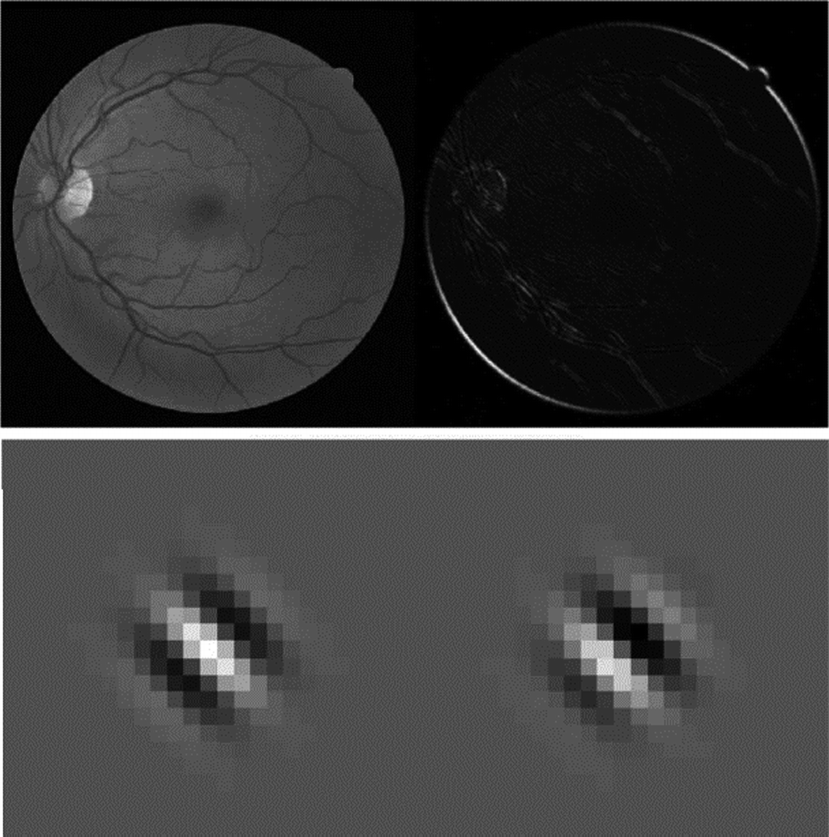 Segmentation of Blood Vessels from Fundus Retinal Images by Using Gabor  Transformation | SpringerLink