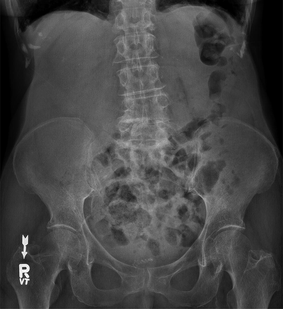 Tutorial 10 The Abdominal Radiograph Springerlink