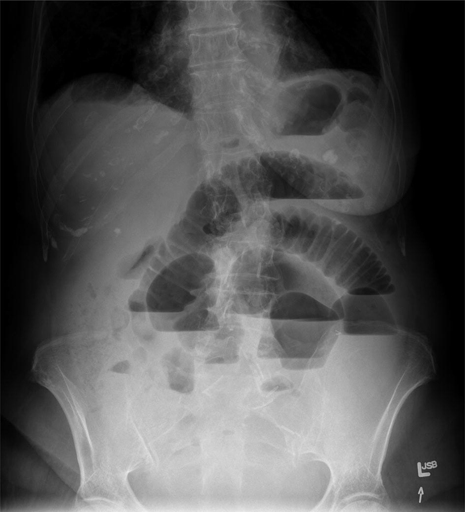 Tutorial 10 The Abdominal Radiograph Springerlink