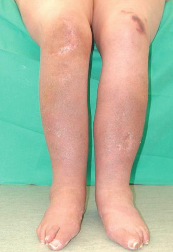 todico varicose tratamentul homeopatiei picioarelor varicoase