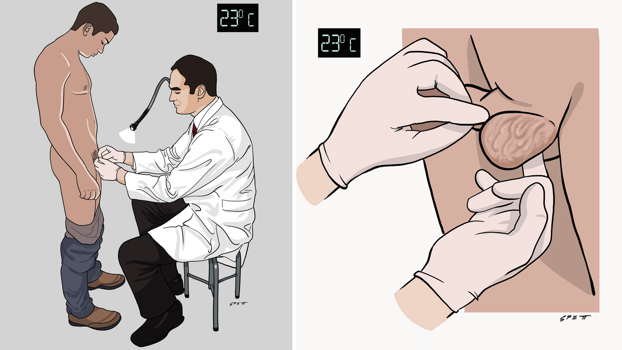 Varicocele | SpringerLink