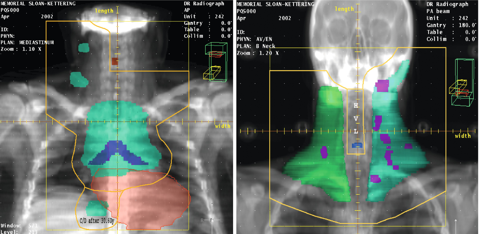 Principles Of Radiation Therapy For Hodgkin Lymphoma Springerlink