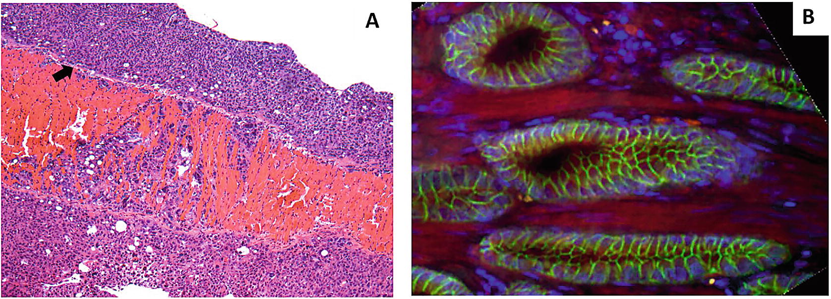 Prostate fibrosis Mi az
