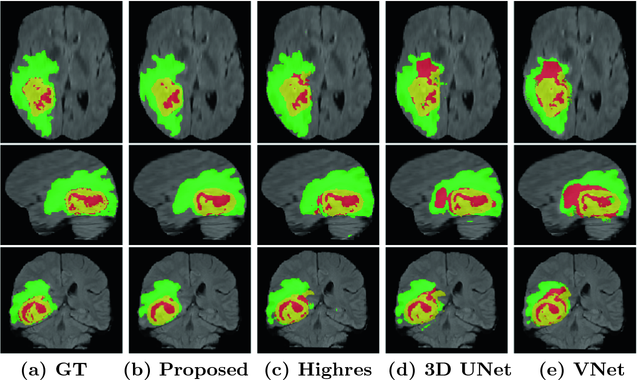 Efficient 3D Depthwise and Separable Convolutions with Dilation for Brain  Tumor Segmentation | SpringerLink