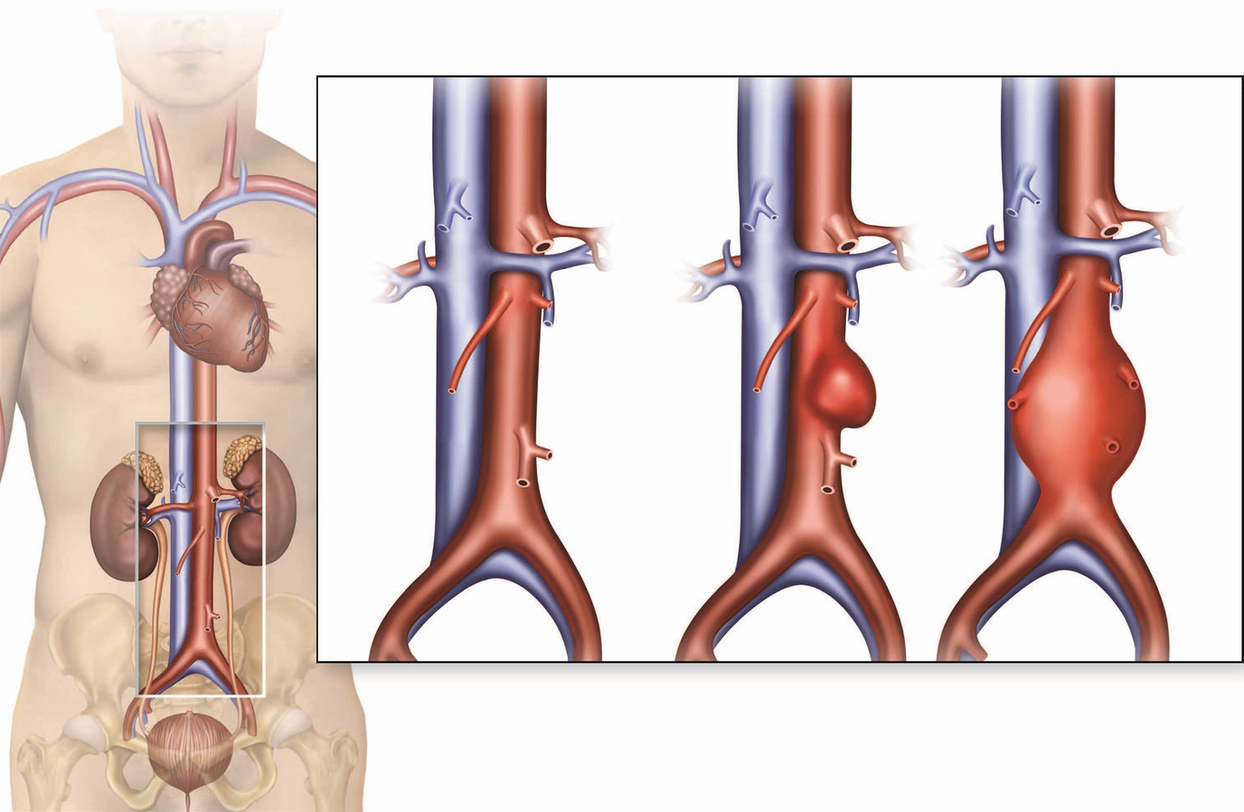 Exercise In Specific Diseases Abdominal Aortic Aneurysm Springerlink