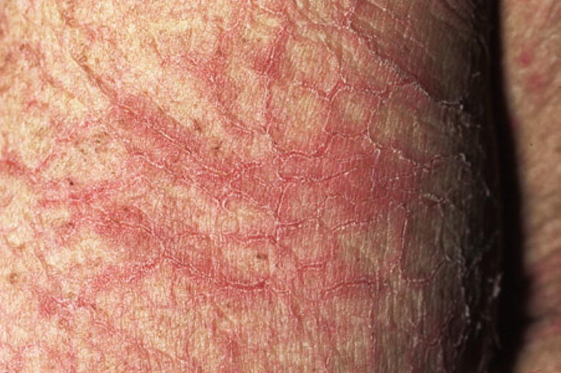 Clinical Features Of Contact Dermatitis Springerlink