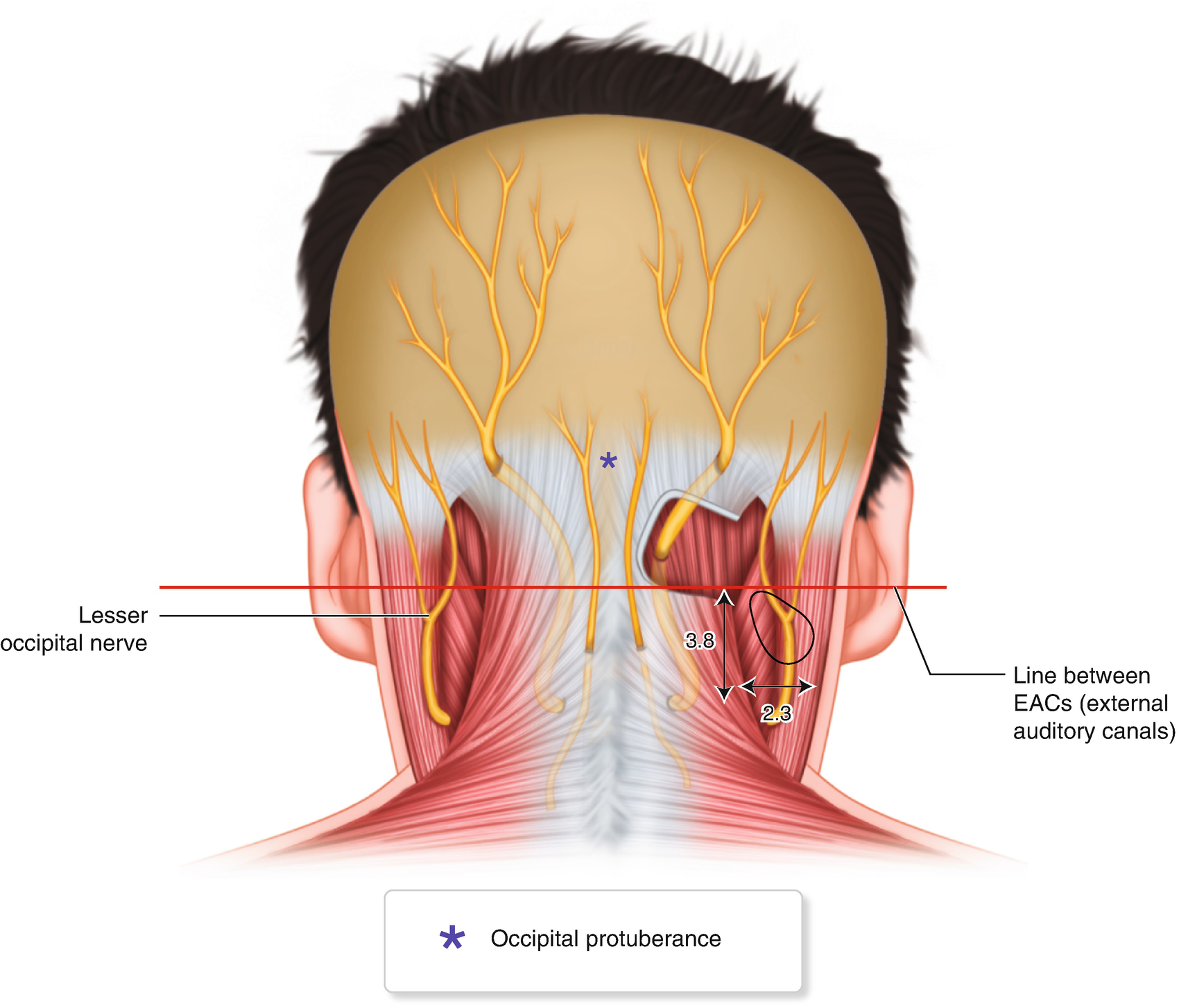 Surgical Treatment Of The Greater Occipital Nerve Springerlink