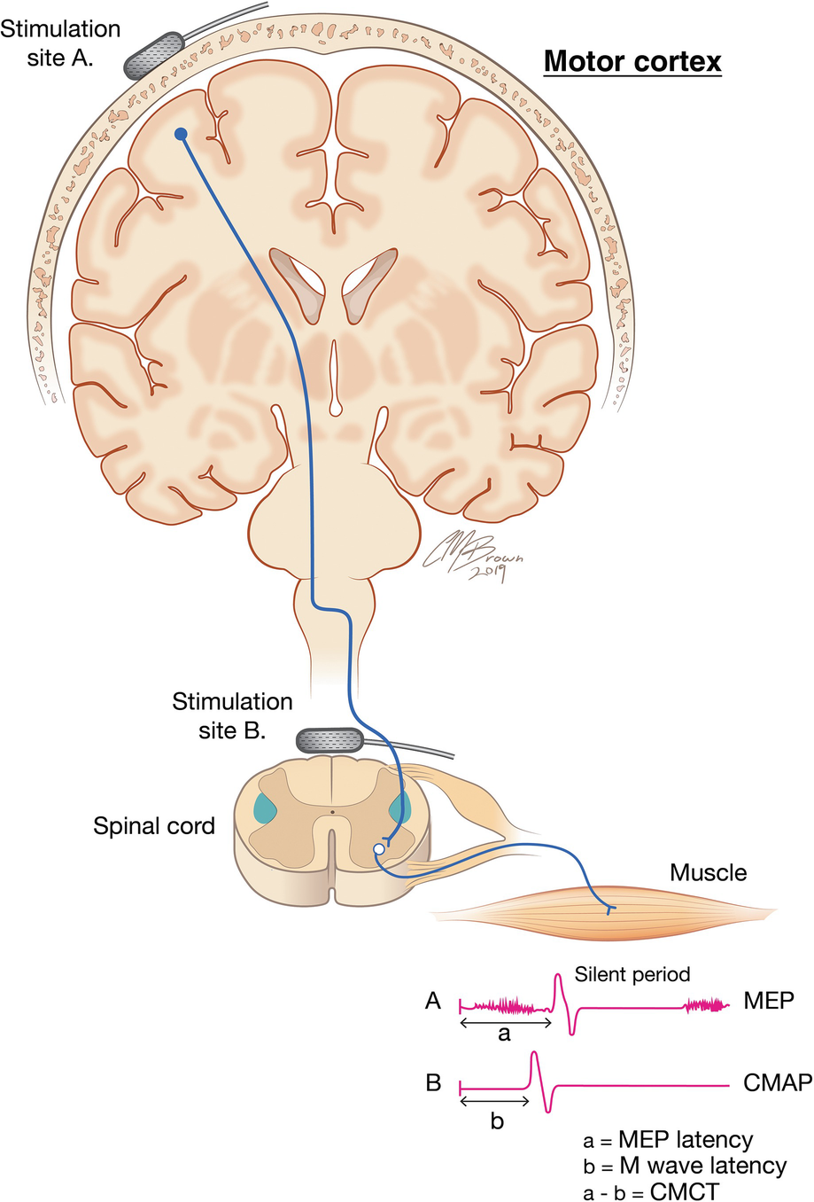 Motor Evoked Potentials Springerlink