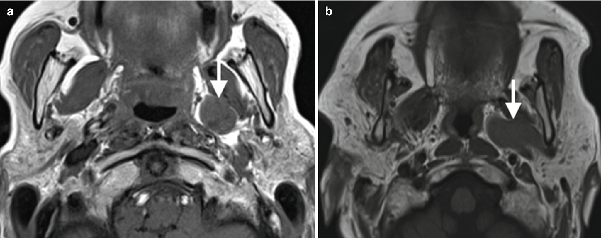 Approach To Masses In Head And Neck Spaces Springerlink