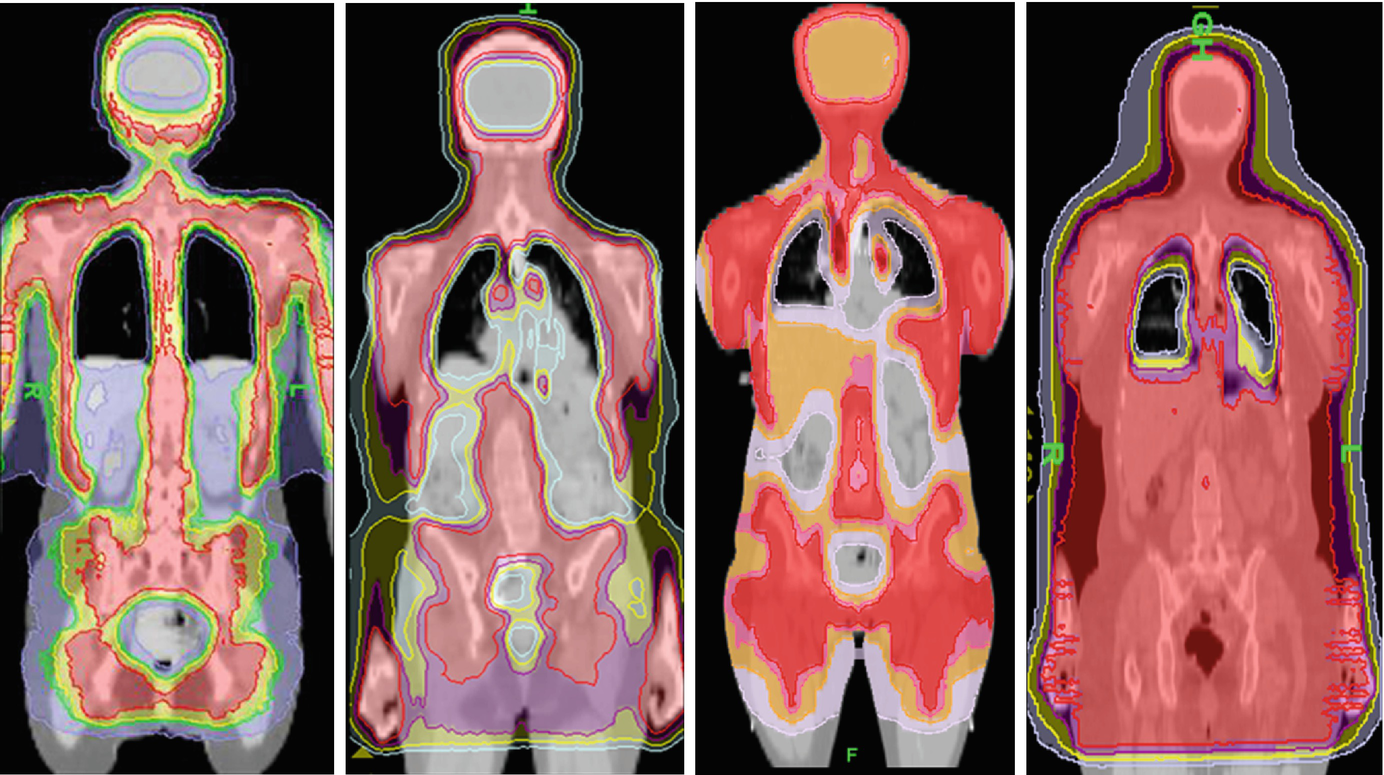 Total Marrow Irradiation Redefining The Role Of Radiotherapy In Bone Marrow Transplantation Springerlink