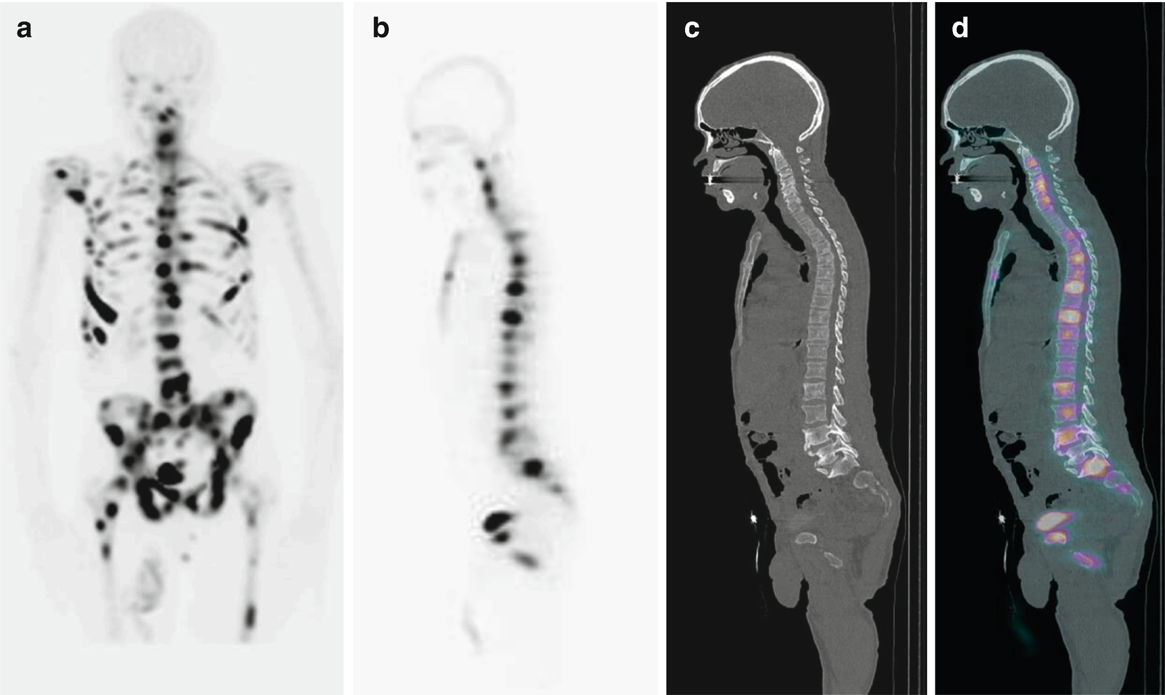 Nuclear Medicine Imaging Techniques Of The Musculoskeletal System Springerlink
