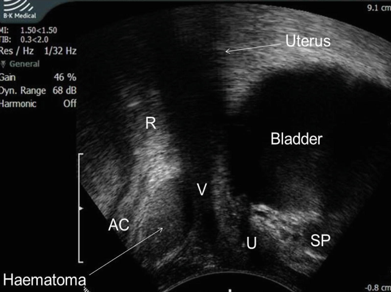 Ultrasonography In The Assessment Of Obstructive Defecation Syndrome Springerlink