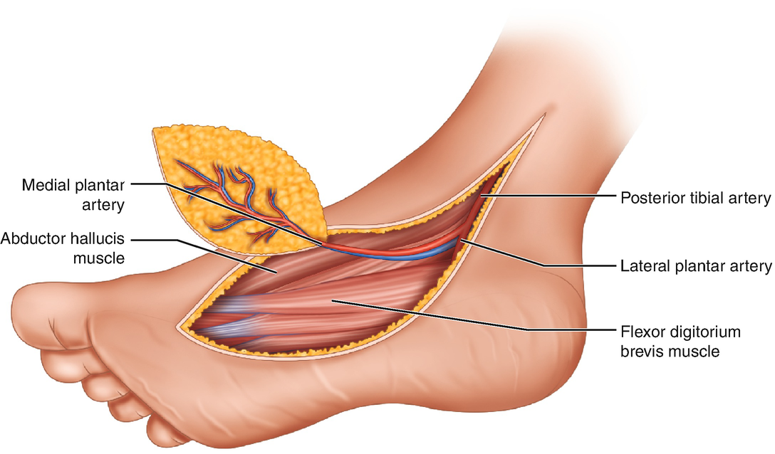 Soft Tissue Reconstruction of the Foot SpringerLink